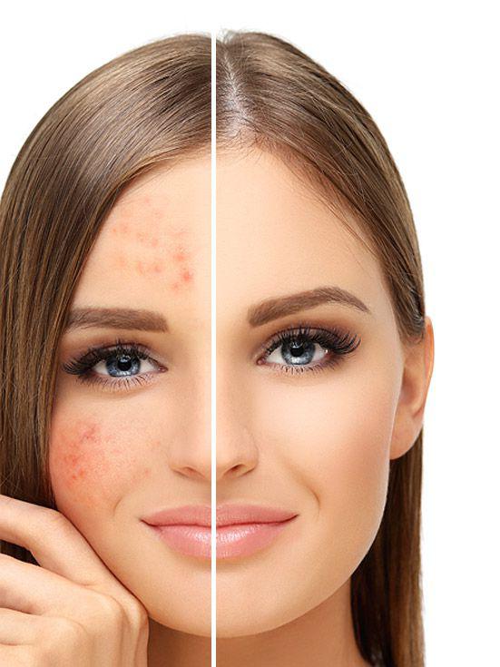 How is Pigmentation Prone Skin different and does it need special daily care?