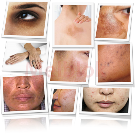 What is hyper-pigmentation?