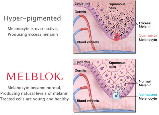 What is Melblok &amp; how does it work?